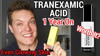 TRANEXAMIC ACID  12 Month Update  Did It Fade My Acne Scars [upl. by Alsworth649]