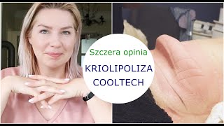 KRIOLIPOLIZA COOLTECH 🔵 BARDZO SZCZERA OPINIA 🔵 PRAWIE idealna [upl. by Nelson333]