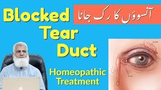 Tear Duct Blockage Homeopathic Medicine  Clogged Lacrimal Sac  Dacryocystitis Treatment [upl. by Maye]