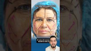 REJUVENECIMIENTO DE ROSTRO DE UNA MUJER DE 81 AÑOS [upl. by Irual]