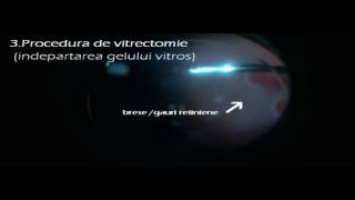 Operatie de vitrectomie pe un ochi cu dezlipire de retina regmatogena [upl. by Assiled]