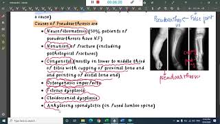 congenital pseudoarthrosis and osteochondritis  Orthopedics [upl. by Robinson]