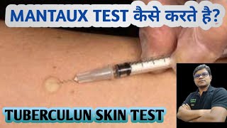 Mantoux test  TST  PPD  Tuberculin skin test  Diagnosis of TB [upl. by Ailisab444]