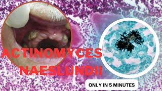 actinomyces microbiology lecture actinomyces naeslundii Easy Microbiology [upl. by Itin]