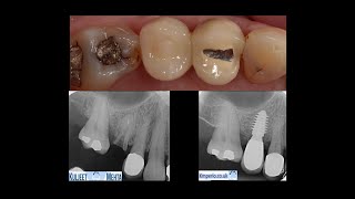 Extraction amp Implant placement with GBR Flap less [upl. by Imer218]