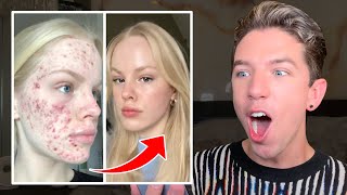 Reacting to MindBlowing Skin Transformations😱 [upl. by Eirak110]