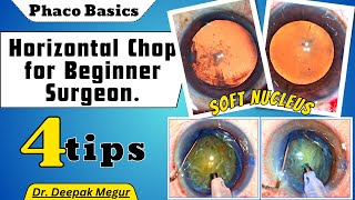 Phaco Basics Horizontal chop for beginner surgeon 4 tips of Horizontal chop  Dr Deepak Megur [upl. by Miarhpe798]