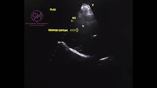 Echocardiography Sigmoid septum [upl. by Nevi314]