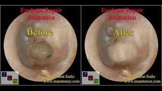 Ear Drum Repair [upl. by Moir]