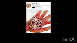 Copy of ASMR Removal Severely Affected trypophobia from Body  Dog Ticks amp Maggots  Live [upl. by Idid]