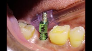 Implant Fixture Level Impression  Open Tray Impression Technique For Implants  Stepwise Procedure [upl. by Ayerim]