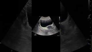 Right ovarian dermoid cyst ultrasound doctor [upl. by Enilehcim]