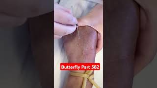 Butterfly  Part 582  Scalping shorts youtubeshorts viralvideo [upl. by Ethe]