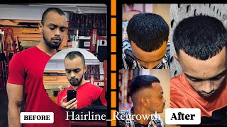 My Honest Review  Hairline Regrowth  How To Grow your Receding hairline [upl. by Imelda690]