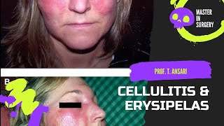 Everything You Need to Know About Cellulitis and erysipelas [upl. by Sanger]