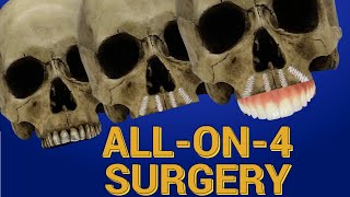 ALL on 4 Dental Implant Surgery StepbyStep Guide [upl. by Dnomaj79]