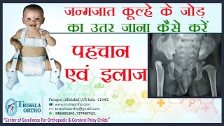 Congenital Hip Dislocation जन्मजात कूल्हे के जोड़ का उतर जाना पहचान एवं इलाज Dr J K Jain [upl. by Slaughter]