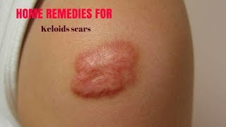 HOME REMEDIES FOR KELOIDS SCARS [upl. by Screens]