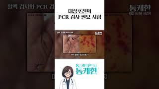 이럴때는 반드시 대상포진 검사PCR 해보셔야 합니다 [upl. by Azyl]