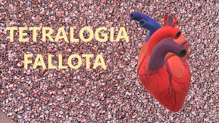 TETRALOGIA FALLOTA  złożona wada serca [upl. by Akenal3]