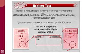 Hematology  2  U1L29  Screening test for sickle cell anaemia  2 [upl. by Snehpets985]