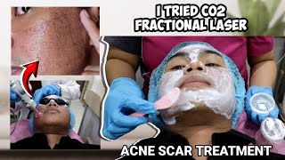 ACNE SCAR TREATMENT I TRIED CO2 FRACTIONAL LASER  SUBCISION FOR ACNE SCARS [upl. by Alfonse]