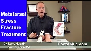 Metatarsal Stress Fractures  How to Diagnose Yourself [upl. by Eanert47]