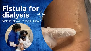 What does a fistula for dialysis look like CHT CERTIFICATION REVIEW 2022 [upl. by Adnert249]