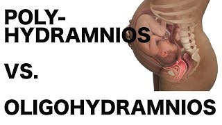 Polyhydramnios vs Oligohydramnios [upl. by Valorie]