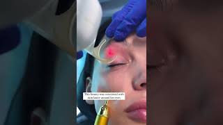 Co2 Laser Skin Resurfacing for Eyelids  Skin Tightening [upl. by Betz]