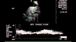 Abnormal Hepatic Venous Flow  Case Study [upl. by Ettennal]