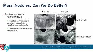 EUS of Pancreatic Cysts What’s New [upl. by Zach]