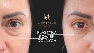 Plastyka powiek dolnych Wszystko co musisz wiedzieć Lek Anna Ptasiński [upl. by Gertruda]