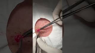 Excision of a Cyst with Complete Sac Removal [upl. by Westleigh]