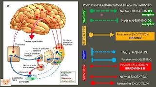 Challenges with Parkinsons disease [upl. by Cynthia]