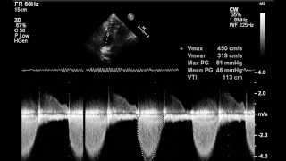 Valvular pulmonary stenosis [upl. by Elton]