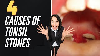 4 Causes Of Tonsil Stones [upl. by Maurita]