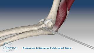 Ricostruzione del Legamento Collaterale Laterale del Gomito con NOVALIG® [upl. by Ardnuhsal]