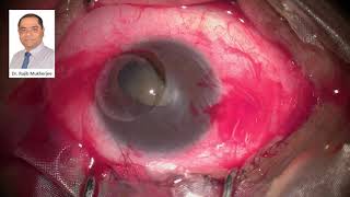 Cornea Patch Graft  Therapeutic Keratoplasty [upl. by Loy]