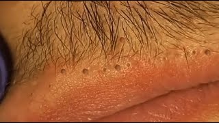 WOOW  BEAUTY OF SQUEEZE😨 BLACKHEADS REMOVAL FROM THE LIPS relaxing blackheads [upl. by Dud]