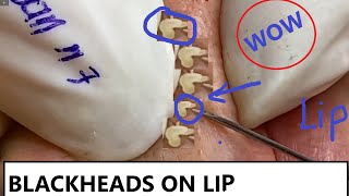 REMOVAL BLACKHEADS ON LIP AND FACE n7  LOAN NGUYEN [upl. by Einnaj890]