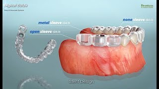 Dentium Digital Guided surgery in case of Sinus septum [upl. by Knah247]