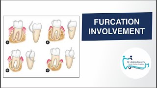 How to record FURCATION INVOLVEMENT GLICKMANS CLASSIFICATION RADIOGRAPHIC FINDINGS DR ANKITA [upl. by Stulin]