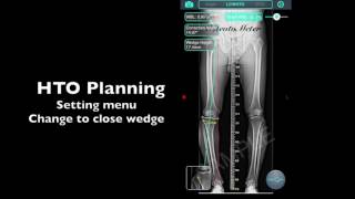 Preoperative planning for HTO amp DFO by iPhone App  OsteoMaster [upl. by Ailel]