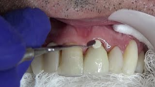 🔴PARTE 2 PASSO A PASSO FACETA DENTE 11 E REPARO EM COROA DENTE 21 🥇IGUALANDO CORES E ANATOMIA🤩🤩🤩 [upl. by Yeldnarb287]