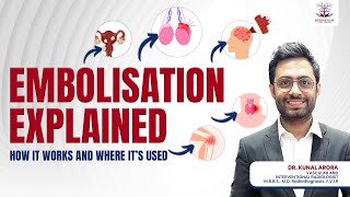 Everything About Embolisation  Non surgical Alternative For Various Diseases  Dr Kunal Arora [upl. by Airel796]