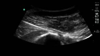 Hip Ultrasound Subglute Max Bursa Injection 2 [upl. by Dugaid]