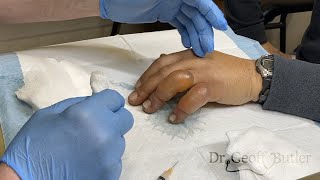 Drainage of blisters secondary to frostbite [upl. by Georgena]