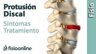 Protrusión de disco o discal  Qué es causas síntomas y tratamiento [upl. by Azzil]