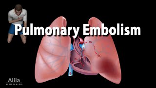 Pulmonary Embolism Animation [upl. by Akirea]